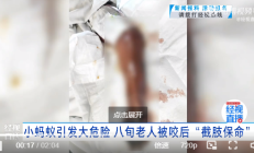 老人手被被蚂蚁咬一口 没在意竟需截肢保命 医生:咬伤后 警惕“危险信号” !