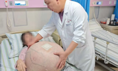 河北一女子肚子长80斤罕见巨瘤：血管暴突如蛛网 4小时切下